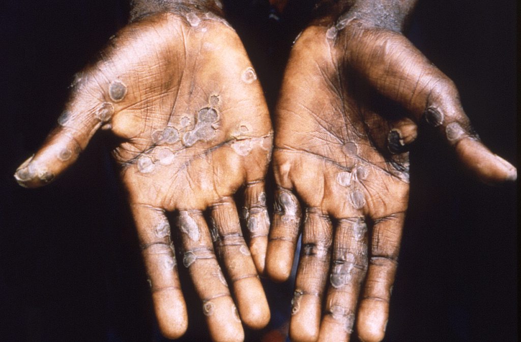 Imagen de las lesiones en la piel provocadas por la viruela del mono. Foto: EFE | Brian W.j. Mahy | Center for Disease Control and Prevention.