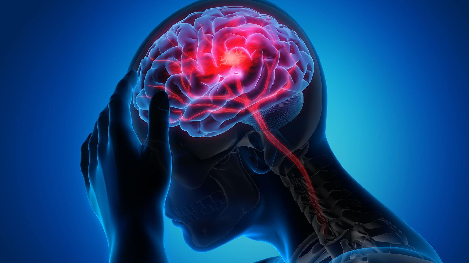 accidente cerebrovascular (ACV)
